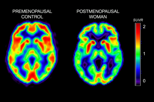 Alzheimers:  Threat is Even Greater For Women